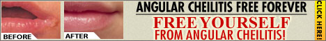 Angular Cheilitis